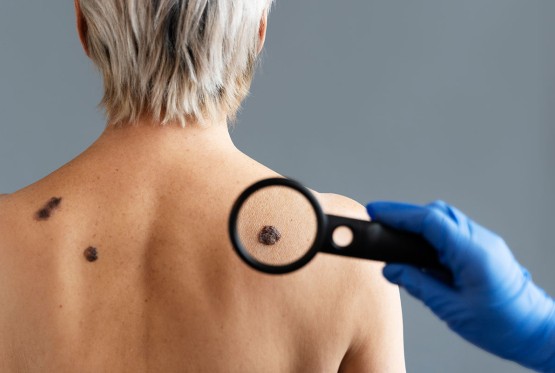 Maj u znaku borbe protiv melanoma, besplatni pregledi u UKC RS 29. maja